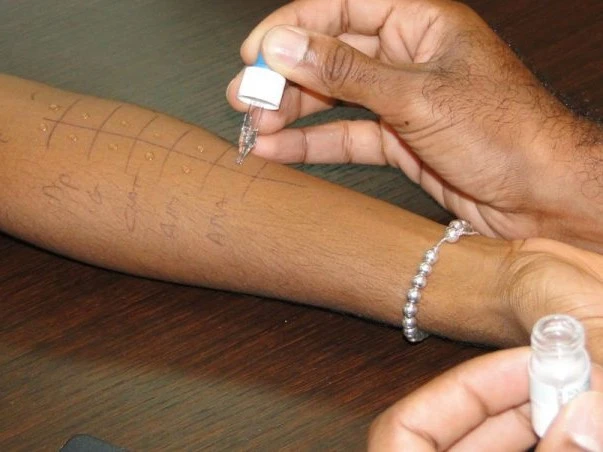 Test allergologique cutané